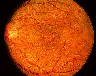 Licence- Wikimedia Commons nSource- https://commons.wikimedia.org/wiki/File:Congenital_Rubella_Syndrome,_Salt_and_Pepper_Retinopathy.jpg nAuthor- Jonathan Trobe, M.D. - University of Michigan Kellogg Eye Center
