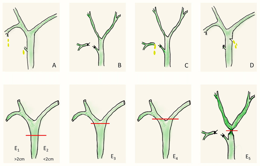 https://www.researchgate.net/figure/Bismuth-Strasberg-classification-of-bile-duct-injury-A-Bile-leak-from-cystic-duct-or_fig2_332358086
