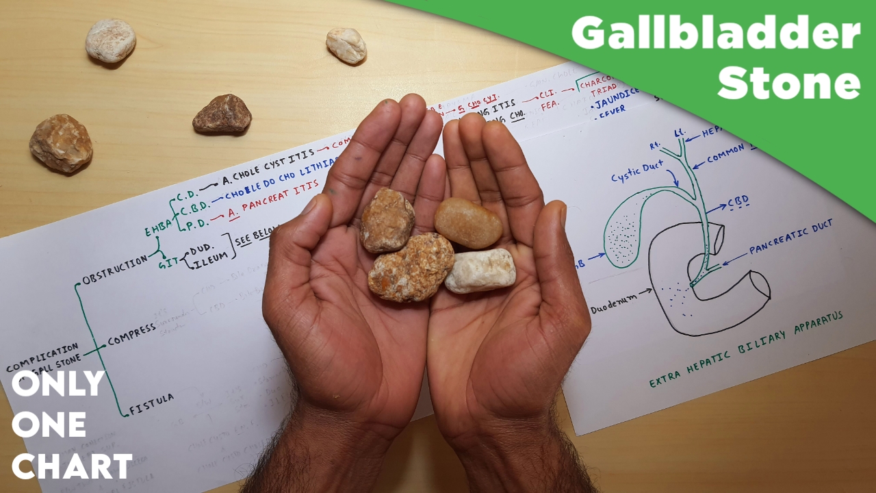 Cholelithiasis or Gallbladder Stone