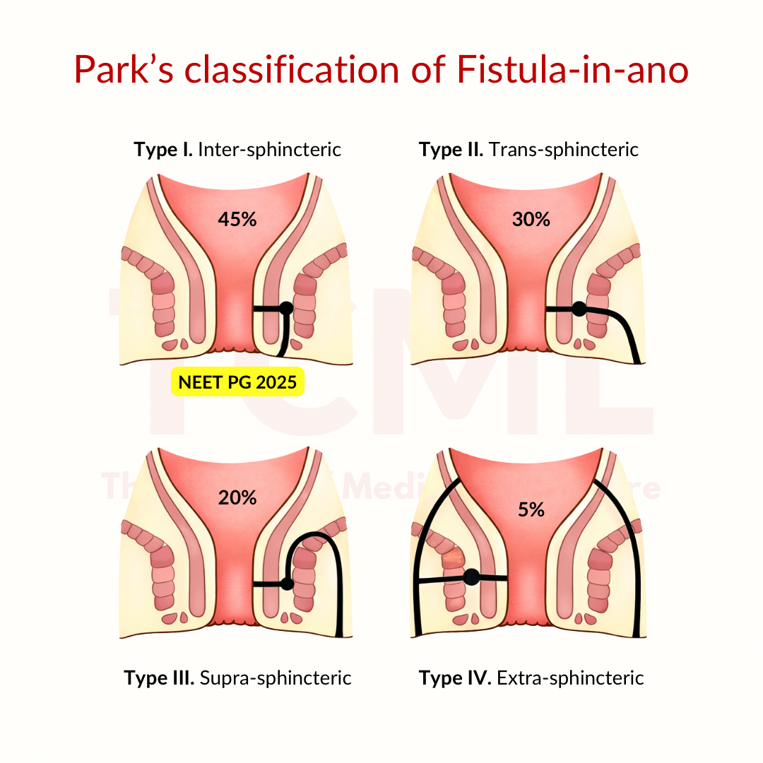 Park’s classification of Fistula-in-ano